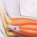 Тендонит на лакътната става: лечение на лакътя