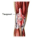 Тендонит на колянната става: лечение на коляното, симптоми на възпаление на сухожилията