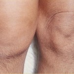 Теносиновит на ставата (глезена, коляното): симптоми и лечение