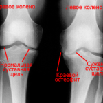 Причини за артроза на колянната става