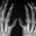 Дебютът на ревматоиден артрит: началото на болестта