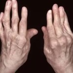 Дебютът на ревматоиден артрит: началото на болестта