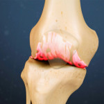 Трън в колянната става: лечение на коляното
