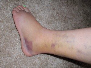 Лечение и рехабилитация след фрактура на стъпалото на стъпалото
