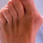 Лечение на артрит на големия пръст: как да се лекува пръстите на краката