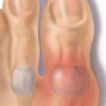 Лечение на артрит на големия пръст: как да се лекува пръстите на краката
