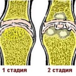 Лечение на артрозата на колянната става на втора степен: как да се третира коляното