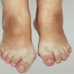 Лечение на остеоартроза на краката: как да се лекуват ставите на краката, степента на заболяването, снимката