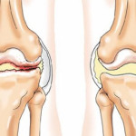 Лечение на ганартроза на колянната става 1 и 2 градуса: как и какво да лекувате