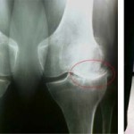 Лечение на ганартроза на колянната става 1 и 2 градуса: как и какво да лекувате