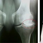 Лечение на ганартроза на колянните стави: как и как да се лекуват коленете