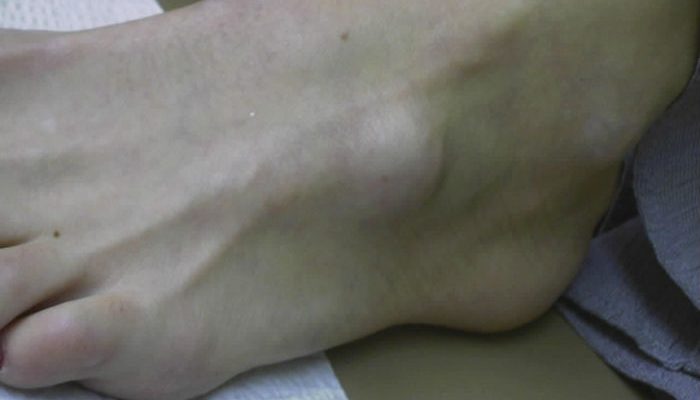 Лечение на хигрома на крака