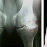 Лечение на полиартрит на ставата (коляно или в същото време всички)