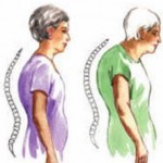 Лечение на остеопорозата при жени в напреднала възраст: лекарства за превенция
