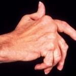 Лечение на остеопорозата на ръцете: как и какво да лекувате