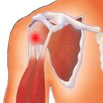 Лечение на сухожилието на раменната става: как да се лекува сухожилието на супраспиналния (бицепса) мускул на рамото
