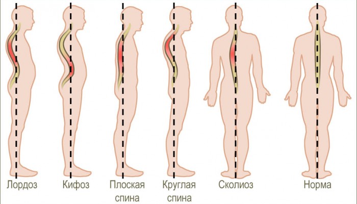 Видове и причини за изкривяване на гръбначния стълб
