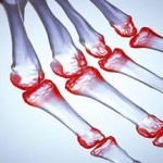 Видове артроза на колянните и тазобедрените стави