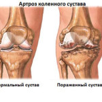Видове артроза на колянните и тазобедрените стави