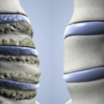 Uncovertebral артроза на шийката на гръбначния стълб: лечение и симптоми на uncoarthrosis на врата