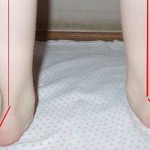 Valgus деформация на крака при дете: лечение на кривина при деца