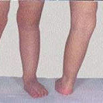 Valgus деформация на колянните стави при деца: лечение на колената