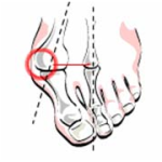 Валгус деформация на пръста: лечение и снимка на крака
