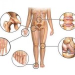 Какви са видовете артрит: класификацията на сортовете