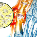 Какво причинява подагра: защо възниква артритен артрит