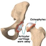 Какво представлява остеофит: причините и лечението на маргиналните костни растежи