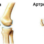 Какво представлява артрозата на колянната става и как да се лекува?
