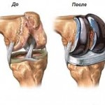 Какво представлява коксартроза на колянната става: лечение, симптоми и признаци