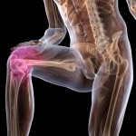 Какво е деформиране на коляното остеоартрит: диагноза на DOA 1 и 2 градуса