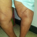 Какво е деформиране на коляното остеоартрит: диагноза на DOA 1 и 2 градуса
