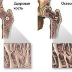 Какво представлява дифузната остеопороза: симптоми и лечение