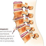 Какво представлява спондилоартроза от 2-ра степен: симптоми и лечение на гръбначния стълб