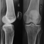 Какво представлява колянната става: лечение, симптоми и признаци