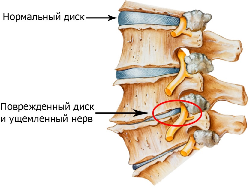 Какво представлява остеохондрозата на гръбначния стълб?