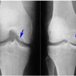Какво представлява остеофитът на колянната става (маргинално): снимка и лечение