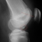 Какво представлява патела хондромалация: симптоми и лечение на колянната става
