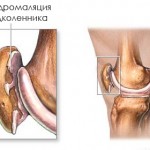 Какво представлява патела хондромалация: симптоми и лечение на колянната става