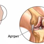 Какво представлява гнойният артрит: симптоми и лечение на колянната става