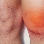 Какво представлява гнойният артрит: симптоми и лечение на колянната става