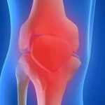 Какво представлява реактивен синовит: симптоми и лечение на колянната става
