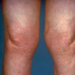 Каква е ревматизма на ставите: симптомите и лечението на краката