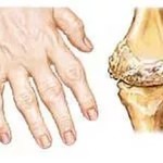 Какво представлява ревматоидният артрит: симптоми, лечение и снимки