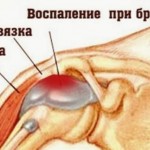 Какво представлява бурситът на раменната става: симптоми и лечение на рамото