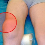 Какво представлява надпушеният бурсит: симптоми и лечение на колянната става