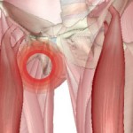 Какво представлява тендоноза: как да се лекува сухожилието на ставите (бедрата и коляното)