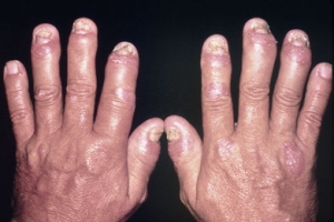 Какво да направите, ако ставите на пръстите са непоносимо болезнени